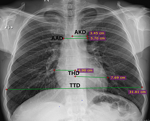 Figure 1 Chest x-ray measurements, aortic knob diameter denoted AKD, aortic arch diameter denoted by AAD, transverse heart diameter denoted by THD (summation of the upper and the lower measurements), and transverse thoracic diameter denoted by TTD.