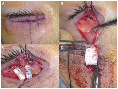 Figure 1 (A) A skin incision was made 5 mm from the eyelid margin for children and 6 mm for adults. This incision was used to create a lid crease in the oriental eyelid. Vertical lateral skin marker lines show the pupil margin and a middle long line shows the pupil center. (B) After the traction sutures were positioned above and below the incision, the orbicularis palpebrae was observed and incised until the tarsal plate was exposed. The lowest part of the aponeurosis was pulled caudally, and the orbital fat was then observed. (C) Gore-Tex® strips (tarsal part) were sutured with 7-0 Prolene using a 3/8-circle round needle (to avoid tearing the sheet) at one half to one third the height of the tarsal plate. Two Prolene sutures were needed to fix one strip on the tarsus. This photograph shows the mid course of surgery. (D) The cranial (frontalis) part of the Gore-Tex sheet was sutured to the frontalis muscle using 7-0 Prolene while eye opening was confirmed.