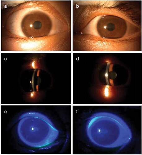 Figure 1. Slit-lamp examination photos on the twenty-fifth day after the second dose of COVID-19 vaccination.