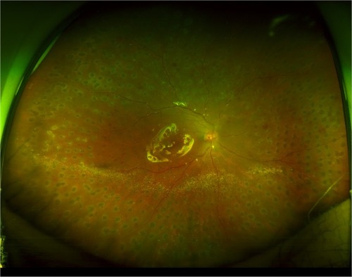 Figure 5 Wide-field fundus photography of the right eye postoperatively demonstrates an attached retina under silicone oil tamponade and full panretinal photocoagulation treatment to all quadrants.