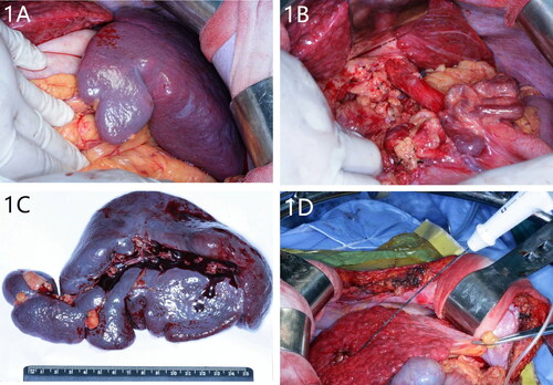 Figure 1. (A) Intraoperative exploration revealed that the patient’s spleen was seriously enlarged. The spleen enlarged beyond the left subcostal margin. (B) The pericardia vessels were dissected upward for at least 5 cm. (C) The removed spleen was severely enlarged. (D) The RFA needle was inserted into the center of the tumor to initiate the radiofrequency ablation.