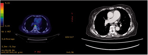 Figure 2. A case demonstrating utility of PET-CT, where it reported FDG-avid aortocaval node that was not picked up in prior CT scan.