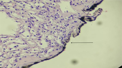 Figure 5 A large number of residual tumor cells at the margin.