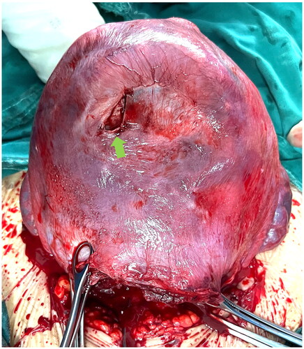 Figure 2. Full-thickness defect in anterior uterine wall (arrow) noticed during cesarean section.