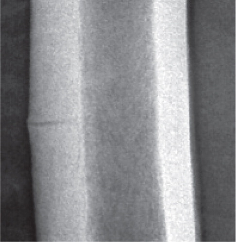 Figure 1. Undisplaced, atypical mid-shaft fracture of the right femur. A thin fracture line extends through the whole thickness of the lateral cortex. Note the subtle callus reaction.