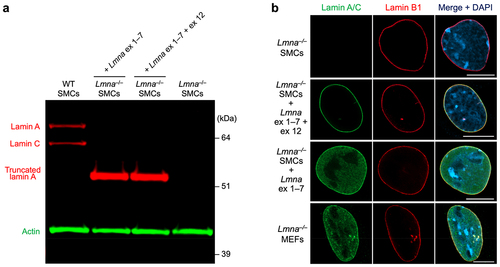 Figure 4. Expression of 54-kDa truncated lamin A proteins in Lmna–/– smooth muscle cells (SMCs). A mutant lamin A containing exon 1–7 sequences (corresponding to Transcript 2–1) and a mutant lamin A containing exon 1–7 + exon 12 sequences (corresponding to Transcript 2–2) were expressed in Lmna–/– SMCs. (a) Western blot of SMC extracts with lamin A/C – and actin-specific antibodies. (b) Confocal immunofluorescence micrographs across the middle of the cell nucleus in the z plane, revealing that the ‘exon 1–7 lamin A’ in Lmna–/– SMCs was predominantly nucleoplasmic (resembling the distribution of the truncated lamin A in Lmna–/– MEFs), whereas lamin B1 was located at the nuclear rim. In contrast, the ‘exon 1–7 + exon 12 lamin A’ was located along the nuclear rim in Lmna–/– SMCs. Scale bars, 10 µm.