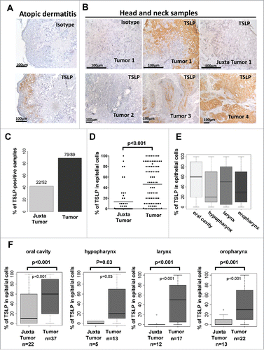 Figure 1. TSLP is highly expressed by epithelial cancer cells in HNSCC. Frozen section of (A) skin lesions of atopic dermatitis and (B) tumor or juxta-tumor samples from 89 patients with primary HNSCC by means of immunohistology for TSLP (brown staining). (C) Percentage of TSLP-positive samples. (D–F) Percentages of TSLP staining in epithelial cells are shown for all patients. (D) Percent of epithelial cells positive for TSLP. Each symbol represents a different sample. (E) Percent of epithelial cancer cells positive for TSLP according to the location of the tumor. (F) Percent of epithelial cells positive for TSLP between tumors and juxta-tumors in each location. Horizontal bars indicate the median. n = 89 tumors and n = 52 corresponding juxta-tumors. p value is significant if p < 0.05.