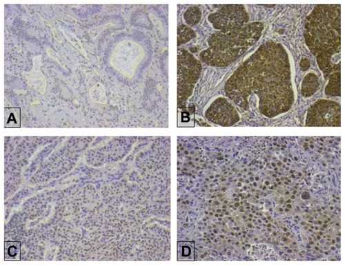 Figure 1 Representative nonsmall cell lung cancer cases with different S100A2 immunohistochemical staining patterns. (A) Negative, (B) cytoplasmic and nuclear, (C) nuclear score 2, and (D) nuclear score 3.