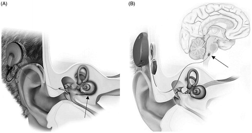 Figure 4. CI system, with a straight longitudinal electrode placed inside the cochlea (black arrow) (A). ABI system, with the pad electrode placed on the CN (black arrow) (B) (image courtesy of MED-EL).