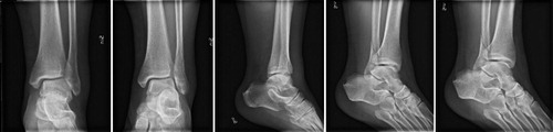 Figure 4. The examination should have been a malleolar type C fracture but the network predicted type B fracture.