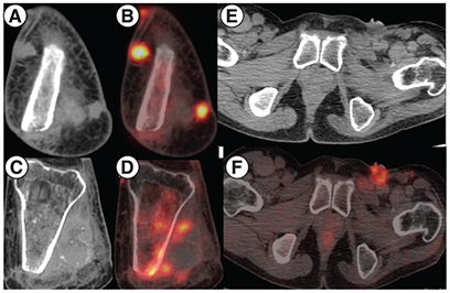 Figure 2. PET scan imaging showing radiographic findings prior to starting tazemetostat.(A & B) MIP image showing focal increased tracer uptake in the left inguinal region and the left knee joint region corresponding to cutaneous nodules at the amputated site of left tibia and fibula on CT showing increased FDG uptake on fused PET-CT. (C & D) Areas of sclerosis in the left tibia with increased FDG uptake. (E–G) Ulcerated left inguinal lymph nodes on CT showing increased FDG uptake on fused PET-CT.CT: Computed tomography; MIP: Maximum intensity projection.