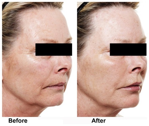 Figure 9 A 57-year-old patient showing self-assessed full facial age decrease of 8 years, with focal areas of upper face showing a decrease of 17 years and lower face showing improvement of 15 years after having botulinum toxin and hyaluronic acid fillers.