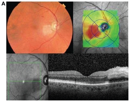 Figure 1a Fundus photograph (Case 1) showing cilioretinal artery occlusion and HD-OCT showing marked thickening of the inner retinal layers in the cilioretinal area that is sharply demarcated from the perfused retina.