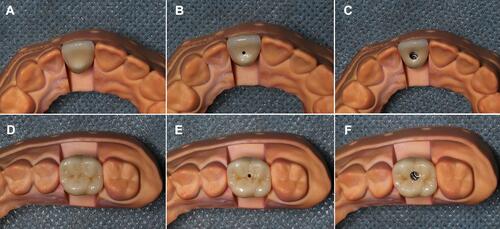 Figure 1 The lingual and occlusal views of crowns on casts with different access hole designs (without resin filling of the holes). (A) anterior crown, no hole (ANH); (B) anterior crown, micro hole (AMH); (C) anterior crown, regular hole (ARH); (D) posterior crown, no hole (PNH); (E) posterior crown, micro hole (PMH); (F) posterior crown, regular hole (PRH).