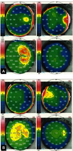 Figure 4 Corneal topography of case 2 (A) before and (B) six months after surgery.