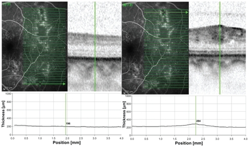 Figure 1 A) Heidelberg Spectralis optical coherence tomography image showing the retinal thickness (located superior temporally within major blood vessels) along the scan in micrometers with the marker located in ischemic retina of a left eye. B) Retinal thickness of the same eye in micrometers along the scan with the marker located in nonischemic retina at corresponding topographic location (which was selected to be ‘mirrored’ around a horizontal axis through the optic nerve).