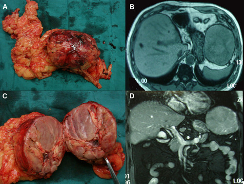 Figure 3 Clinical picture of patient 4. (A) Giant metastatic tumor of omentum; (B) Horizontal plane of magnetic resonance images; (C) Tumor section specimen; (D) Coronal plane of magnetic resonance imaging.