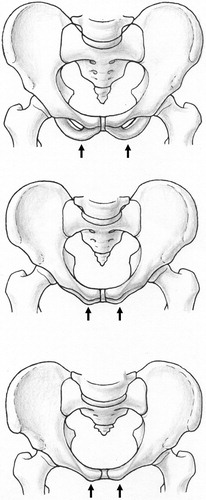 Figure 7. The inferior pubic ramus can simulate the pubic tubercle if the superior and inferior pubic rami are not correctly overlaid.