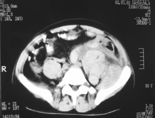Figure 2. On contrast-enhanced pelvic CT image, large retroperitoneal hemorrhage involving all retroperitoneal structures.