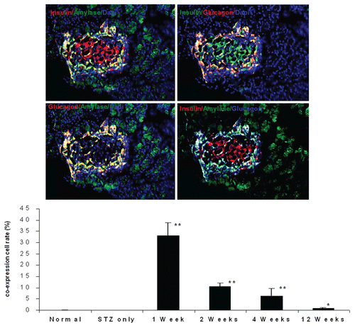 Figure 5 Immunofluorescent images one week after UTMD with GLP-1/cyclin D2/CDK4 (animals euthanized one week after UTMD), showing co-expression of insulin and amylase (upper left), insulin and glucagon (upper right), glucagon and amylase (lower left), and insulin, amylase and glucagon (lower right). The coexpression of insulin, glucagon and amylase indicates pluripotent pancreatic progenitors within an adult pancreatic islet. x200 magnification. Bottom panel is a plot of percentage of co-expression of insulin, glucagon and amylase in total β cells for the different experimental groups. *p < 0.05 vs. Normal group and STZ group; **p < 0.0001 vs. normal and STZ groups. n = 6 animals, Error bars represent mean ± SEM, N values are numbers of pancreas analyzed for each group.