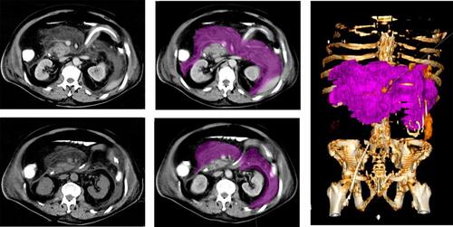 Figure 1 Axial CT images show volume measurement workflow.