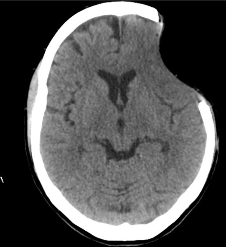 Figure 2 Cranial computed tomography before performing cranioplasty.