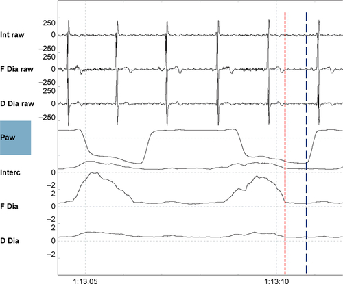 Figure S8 Delayed cycling.Notes: Shown are (from top to bottom) the raw intercostal signal (Int raw), the raw frontal diaphragm signal (F Dia raw), the raw dorsal diaphragm signal (D Dia raw), the pressure wave (Paw), the average intercostal signal (Interc), the average frontal diaphragm (F Dia) signal, and the average dorsal diaphragm signal (D Dia). The electromyography activity has already ceased (end of the electromyography activity depicted by the red dotted line), while the pressure wave continues, (end of the breaths depicted by the straight blue line).