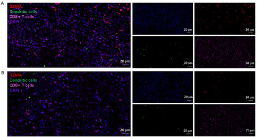 Figure 9 Detection of immune infiltration levels of dendritic and CD8+ T cells in breast cancer using multiplex quantitative immunofluorescence. (A) Relatively high GZMA expression in breast cancer tissue. (B) Relatively low GZMA expression in breast cancer tissue. Representative fluorescence images showing the detection of immune cell samples by simultaneous staining of DAPI, GZMA (red channel), CD8A (pink channel), and HLA-DPB1 (green channel) in breast cancer. CD8+ T-cell marker: CD8A; Dendritic cells marker: HLA-DPB1.