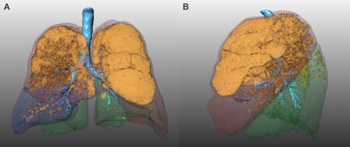 Figure 2 3D surface views of the lung of a 59-year-old male smoker with COPD GOLD 3 (A, B). Coronal (A) and sagittal (B) reconstructions of a CT scan acquired at full inspiration demonstrates a predominant emphysema distribution in the upper lobe.