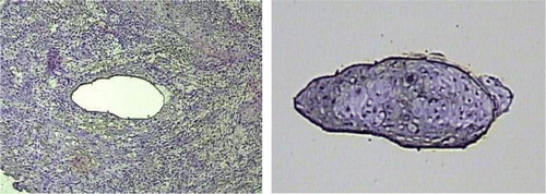 Figure 1.  Laser-capture microdissection of OSCC; tumor cryosections were fixed, stained with hematoxylin and eosin (H&E), dehydrated and analyzed under the microscope. Once tumor cells of interest were identified, microdissection was performed, and the cell purity confirmed by inspecting the area of tissue that underwent procurement and the captured cells.