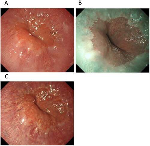 Figure 3. Images of Barrett’s epithelium taken using a third-generation ultrathin endoscope with white-light imaging (WLI) (A), narrow-band imaging (B), and texture and colour enhancement imaging (TXI) mode 2 (C). TXI mode 2 shows whitish changes in the oesophagocardial junction more clearly than WLI.