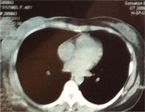 Figure 3 Enhanced computed tomography scanning showed lung metastases.