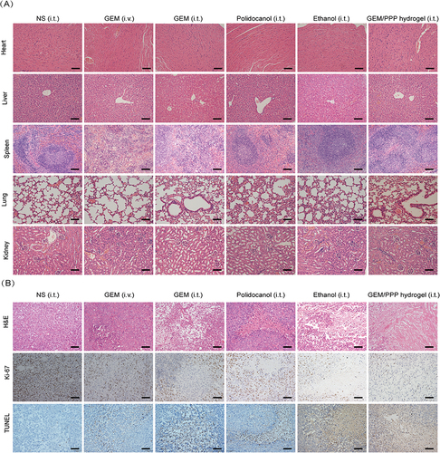 Figure 8 The evaluation of anti-tumor efficacy and systemic toxicity through pathology. (A) Representative micrographs of major organs stained by H&E. Splenic hyperplasia was observed in the GEM (i.v.) and (i.t.) group, suggesting extramedullary hematopoiesis and splenic damage. Hepatic pericentral steatosis was observed in the GEM (i.t.) and ethanol (i.t.) group, indicating liver damage. No tissue damage was seen in GEM/PPP hydrogel (i.t.) group. (B) Representative micrographs of tumor sections stained by H&E, Ki-67 and TUNEL. Scale bar is 100 μm.