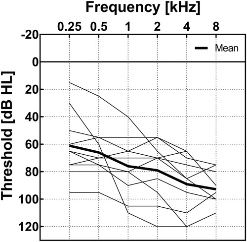 Figure 1 Pure-tone thresholds for the HA ear of the 10 bimodal participants. The thick line represents the mean pure-tone thresholds