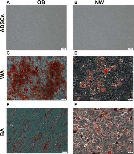 Figure 2 Human adipose-derived stem cells (ADSCs) were induced to differentiate into mature adipocytes. (A, C and E) show the cell images of the obese (OB) group. (B, D and F) show the cell photo of the normal-weight (NW) group. (A and B): ADSCs; (C and D): adipocytes with white adipocyte (WA)-induction treatment (14th day). (E and F): adipocytes with beige adipocytes (BA)-induction treatment (14th day). Oil red O staining image showed lipid droplet in differentiated adipocytes. Scale bar: 50 μm for differentiated adipocytes, 200 μm for ADSCs.