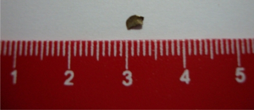 Figure 2 Foreign body removed from lens. It was about 2 × 2 mm in size.