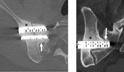 Figure 4 40-year-old woman with 60-month follow-up CT after right SIJF procedure. Axial (A) and coronal (B) bone windowed CT images demonstrate bridging bone adjacent to the middle implant (white arrows) and positive bone remodeling adjacent to the implants (black asterisks).