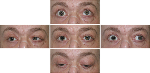 Figure 1. Motility examination reveals orthotropia in primary gaze, marked limitation in adduction, abduction, supraduction, and less in infraduction, as well as a non-reactive mydriasis of the right eye.