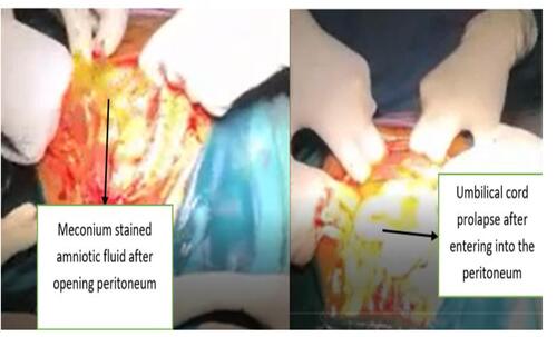 Figure 2 Amniotic fluid leaking and cord prolapsing upon abdominal entry.