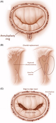 Figure 2. Surgical repair techniques. Quadrangular or triangular incision of isolated prolapse of P2 (Panel A). The remaining parts of the posterior leaflet (P1 and P3) are approximated and an annuloplasty ring is used to stabilize the annulus, thus preventing progressive dilatation. Chordae tendineae replacement (Panel B) with an artificial Gore-Tex (ePTFE) sutures to substitute ruptured or elongated chordae. Edge-to-edge repair (Panel C) is performed by sewing the anterior and posterior leaflets together at the central points of their middle segments to correct anterior or bileaflet prolapse while leaving a double-orifice mitral valve. Reprint with permission from Verma et al. [Citation9].