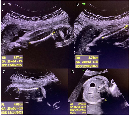 Figure 1 Antenatal ultrasound showing (A) short tibia, (B) short fibula, (C) short femur, and (D) abdominal circumference.