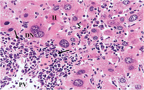 Figure 5. A photomicrograph of a liver section of HCC control group mouse showing altered liver tissue. The hepatic strands are disorganized, and the hepatocytes (H) are well-differentiated with eosinophilic cytoplasm. The nuclei are pleomorphic, relatively large, and some are dividing (DN). Portal vein (PV) with inflammatory infiltrate (arrows) and sinusoids (S) are also seen (HX & E x400).