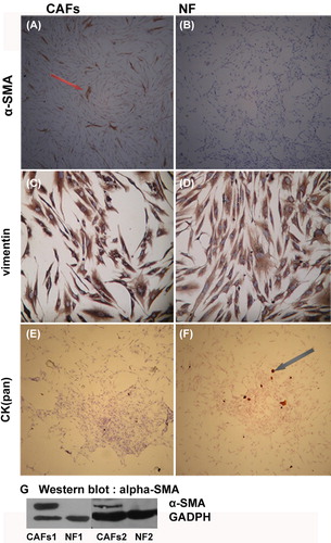 Figure 3. Immunocytochemistry and Western blot analysis of the identification of CAFs/NF. CAFs positive forα-SMA positive (A, brown), and all the NFs were negative for α-SMA (B). Both the CAFs and the NFs expressed, vimentin (C, D: brown), but lacked CK (pan) expression (E, F). Few CK (pan) positive epithelial cells were mixed with NF in Figure F. Figure G shows the result of Western blot analysis for validation of α-SMA expression. Western blot analysis confirmed the α-SMA expression in CAFs and but not in NFs. A, B, E, F 50-fold; C, D 200-fold.