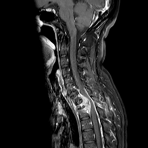 Figure 1 MRI indicated abnormal signal of thoracic vertebra 1, 2 and soft tissue around the appendix of the vertebra.