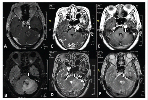 Figure 1. MRI of a 75-y-old female with lung adenocarcinoma and brain metastasis at three time points. At time point 1 (16 February 2016), prior to treatment, a large region of edema was observed in the tissue surrounding the brain metastasis according to gadolinium-enhanced T1-weighted MRI (A) and T2-weighted FLAIR MRI (B). Following administration of a single dose of bevacizumab (2.9 mg/kg) on 19 February 2016, gadolinium-enhanced T1-weighted MRI (C) and T2-weighted MRI (D) were performed at time point 2 (23 February 2016) and the volume of edema was found to be reduced. After the patient received a CyberKnife treatment and gefitinib treatments for an additional 15 months, gadolinium-enhanced T1-weighted MRI (E) and T2-weighted MRI (F) performed at time point 3 (18 July 2017) showed the brain tumor was well controlled.