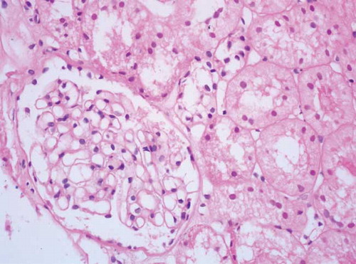 Figure 1.  Light microscopic appearance of glomerulus from the patient with de novo MN (the capillary walls are diffusely thickened without an increase in mesengial cells or matrix; hematoksilen-eosin, original magnification ×400).
