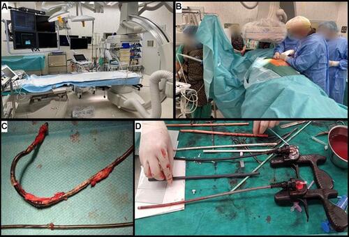 Figure 1 (A) Hybrid operating room. In the background a table with surgical instruments designed for sternotomy. (B) Cardiac surgical and anesthesia team and an echocardiographer performing TEE monitoring (C) Removed leads. Thick fibrotic tissue with calcific changes around the leads, and a variety of damage to outer silicone tube (mechanical damage during extraction and an old abrasion – dark color of the distal end of the lead). (D) “After the battle”. The tools used for lead extraction: conventional mechanical non-powered sheaths (Byrd polypropylene sheaths, Cook) in three sizes and mechanical rotational threaded sheaths - Evolution (Cook) – two sizes.