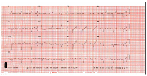 Figure 1 Electrocardiogram in a patient with CS demonstrating first-degree heart block and left anterior hemiblock.