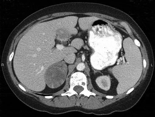 Figure 1. Axial computed tomography showing a low attenuating right adrenal mass, which proved to be an adrenal collision tumor on pathology.