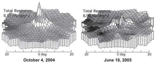 Figure 4 Results of a serial study taken over 10 months after patient stopped taking hydroxychloroquine. The panel on the right shows a dramatic reduction in the central responses that occurred despite stopping the medication.